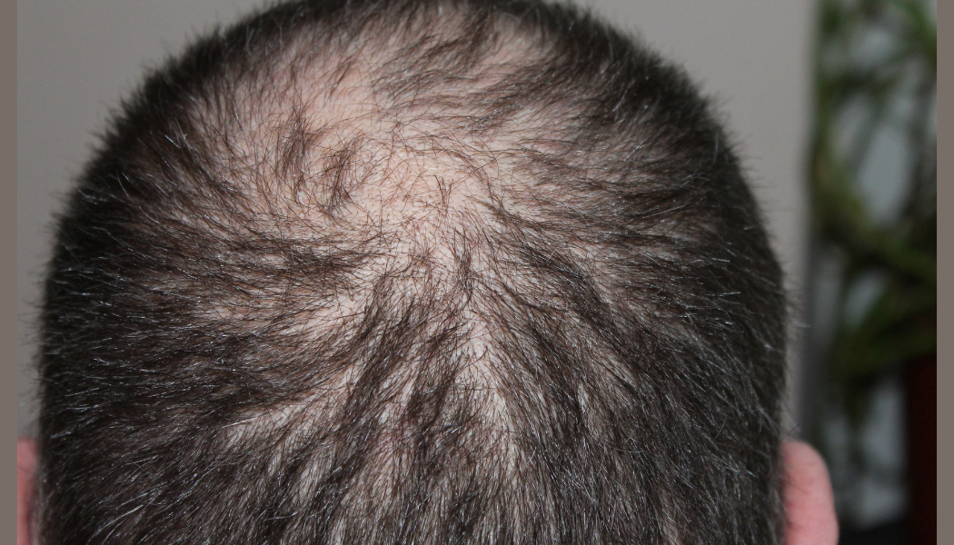 hair transplant in bangalore budget friendly for uae and gulf